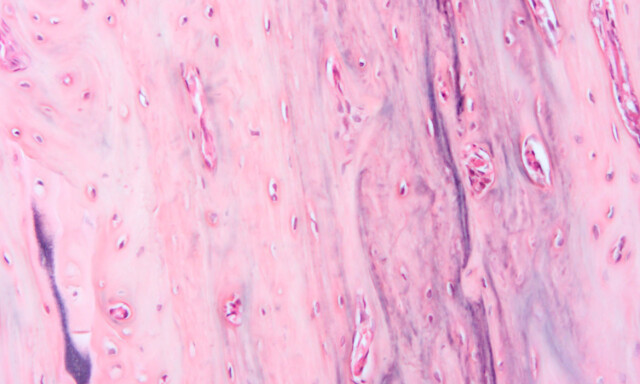 image: Mixed Connective Tissue Disease (MCTD)